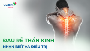 Đau rễ thần kinh