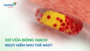 Xơ vữa động mạch